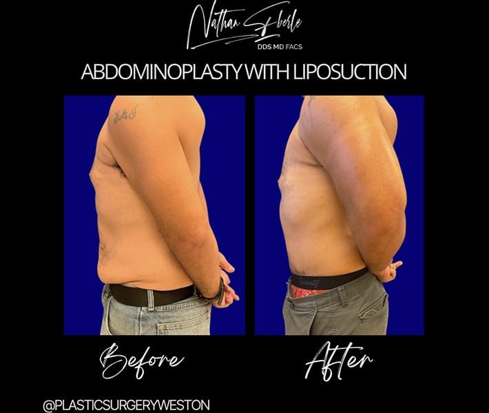 Abdominoplasty_with_Liposuction_11_