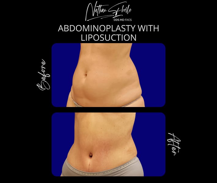 Abdominoplasty_with_Liposuction_5_