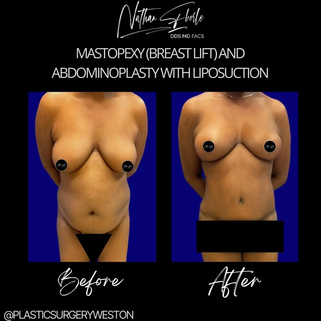 Mastopexy-and-Abdominoplasty-with-Lipo-Jan.webp