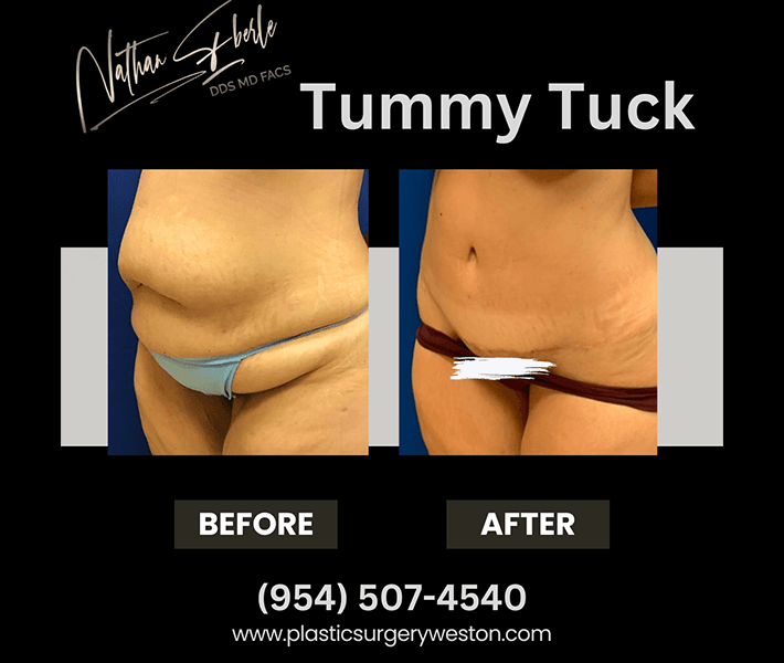 Tummy_Tuck_1_