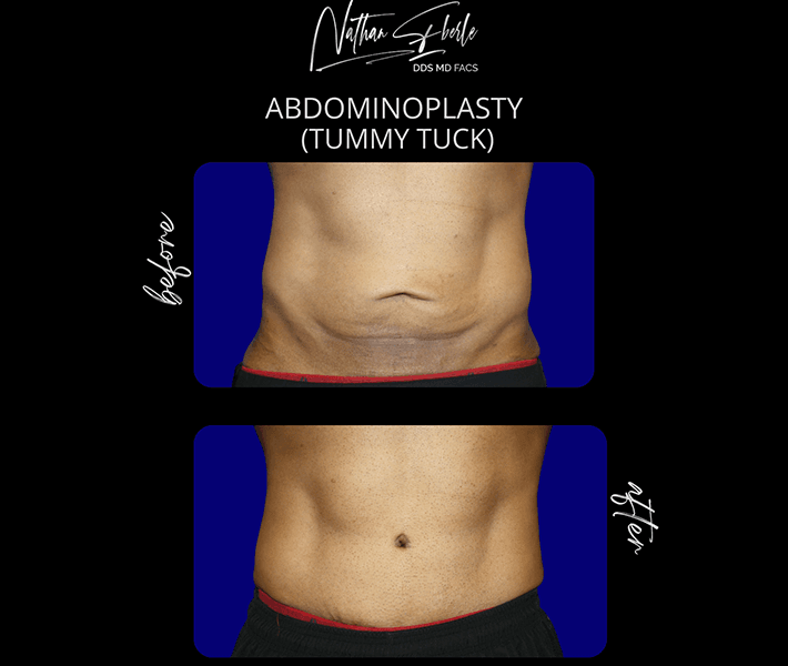 Tummy_Tuck_1_1