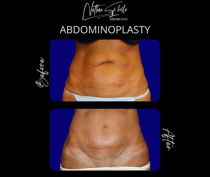 Tummy_Tuck_2_1