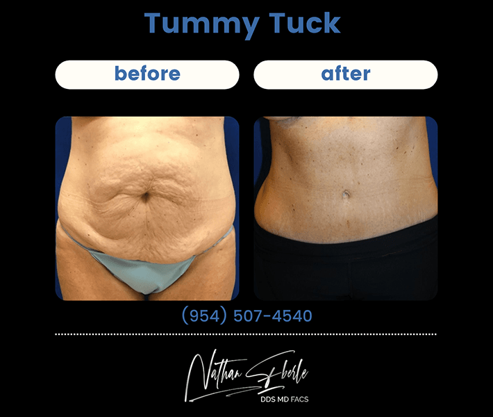 tummy_tuck_2_
