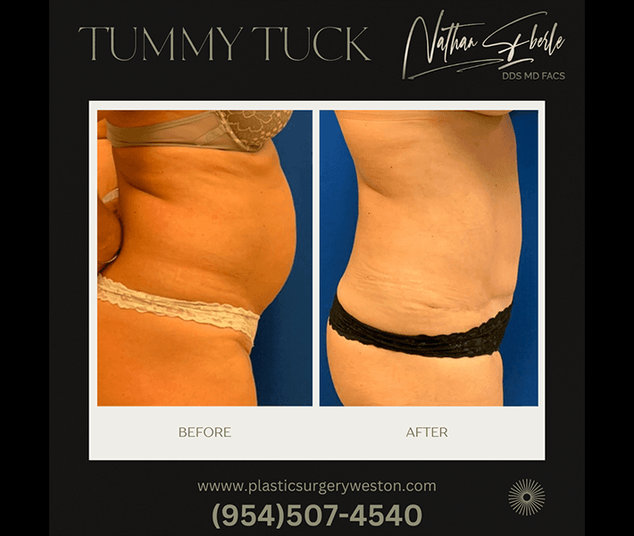 tummy_tuck_8_